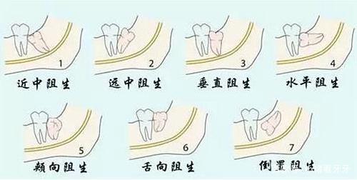 發(fā)炎的智齒什么時候拔才好？有些情況不能拔