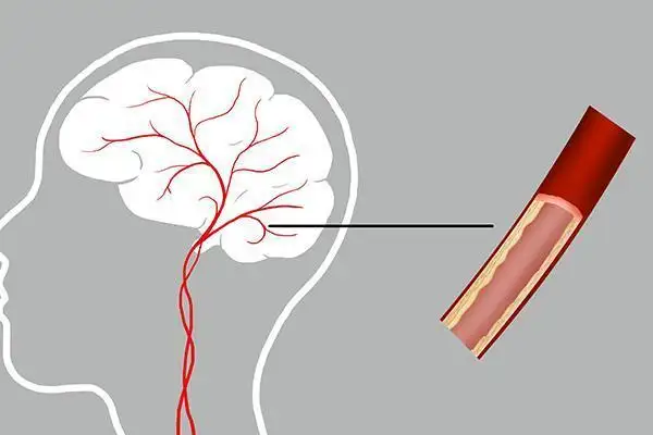 提醒中老年人：腦供血不足時(shí)，身體會(huì)發(fā)出4個(gè)信號(hào)！該如何治療？