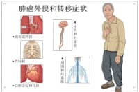 腿疼被診斷為肺癌晚期？腿上出現(xiàn)這4種現(xiàn)象，千萬(wàn)要注意！